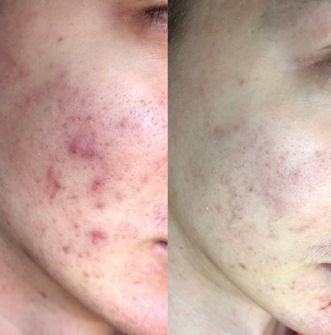 Mezoterapia mikroigłowa Dermapen 4.0 w Krakowie – Femmalium Clinic